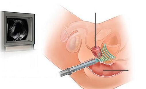 probleme urinare la bărbați minerale din prostatită